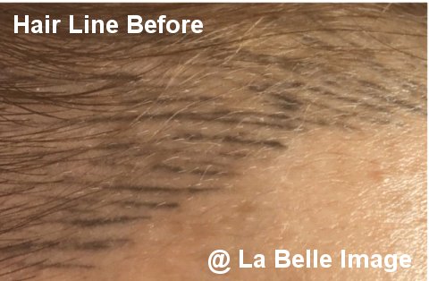 Hair Line Permanent Make Up Before Removal